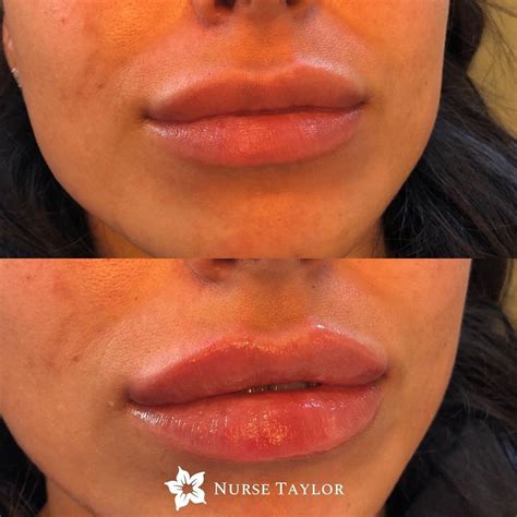 lip fillers near me ava|lip fillers near me.